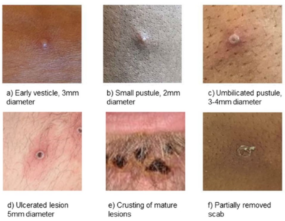 All the different ways the mpox can look