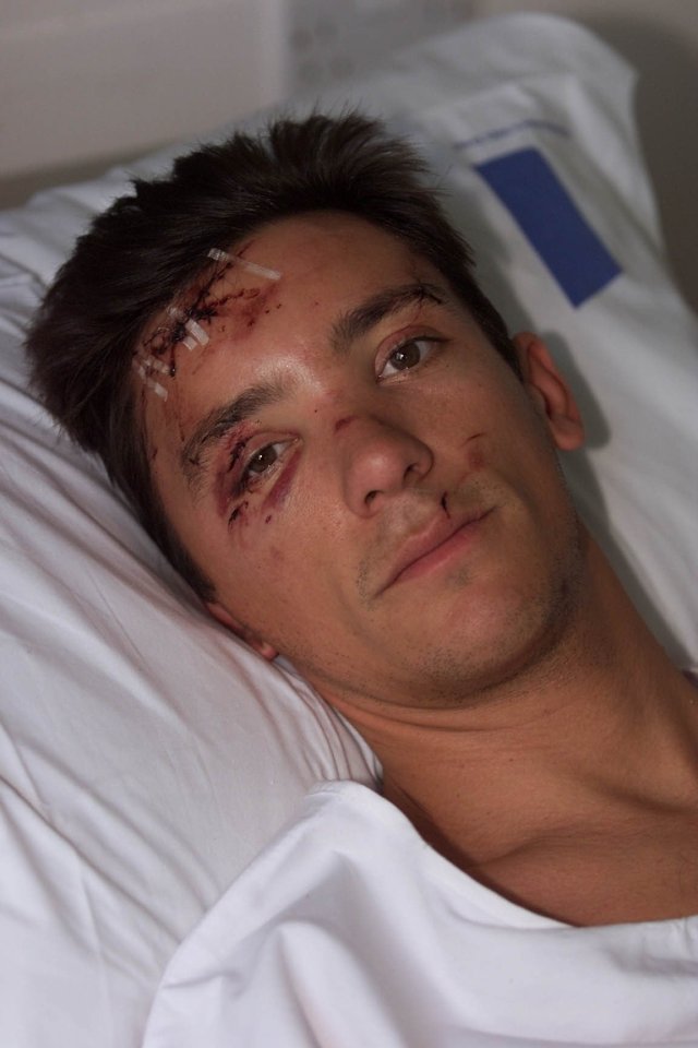 a man laying in a hospital bed with stitches on his head