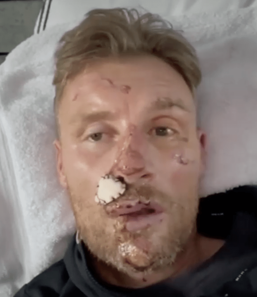 Close-up of Freddie Flintoff's injured face.
