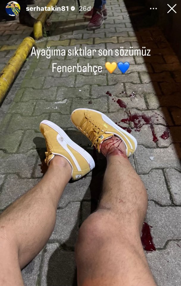 Akin, 43, posted a picture of his injuries on Instagram