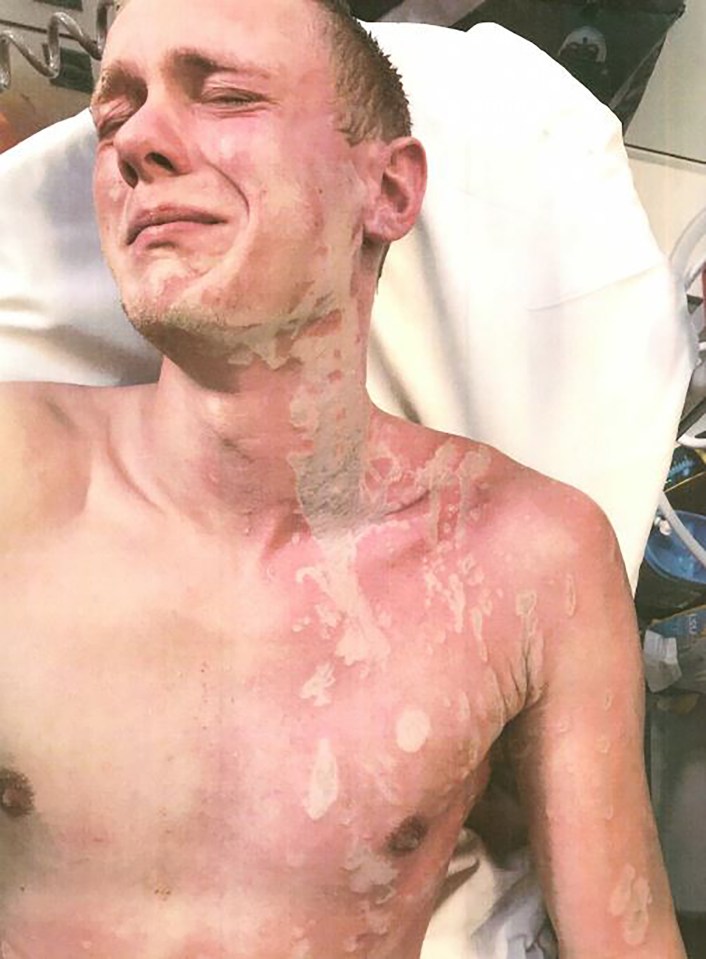 Joe Davies suffered horrendous burns after being attacked with drain cleaner by Roger Comer in 2019