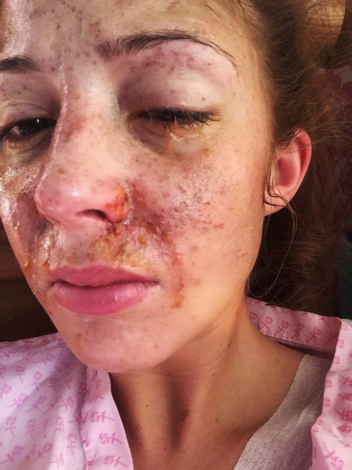 Sophie Hall who was scarred in an acid attack by Arthur Collins