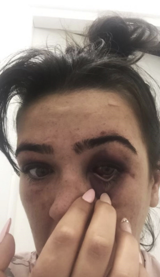 a close up of a woman 's face with a black eye