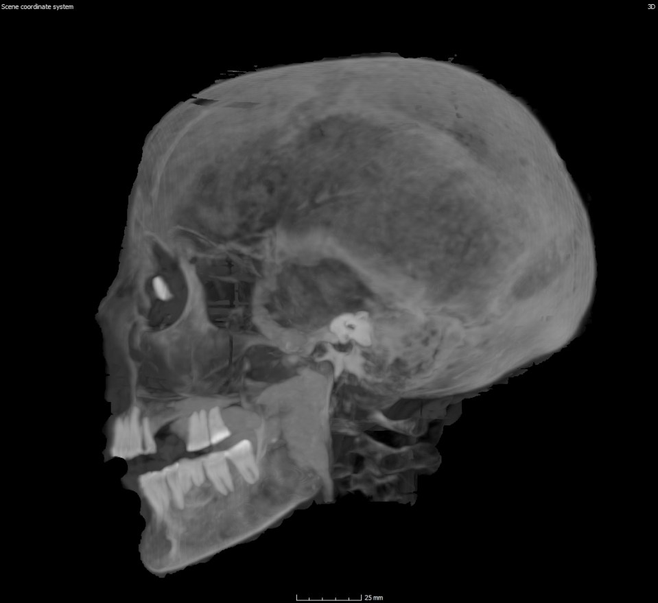 an x-ray of a human skull is shown on a screen that says scene coordinate system