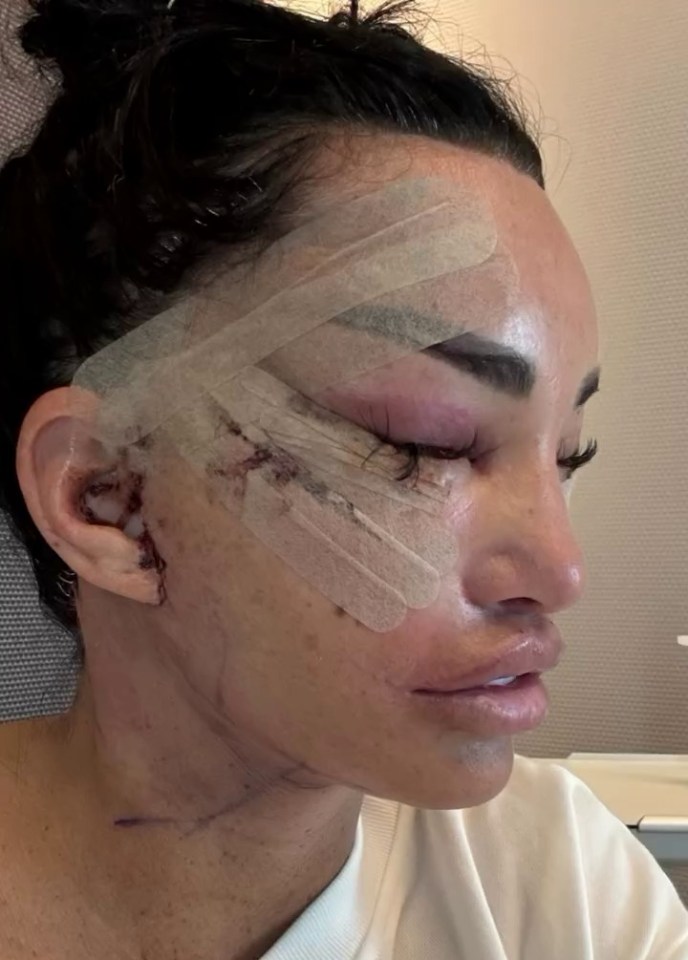 Close-up profile view of a woman's face with bandages and stitches after facial surgery.