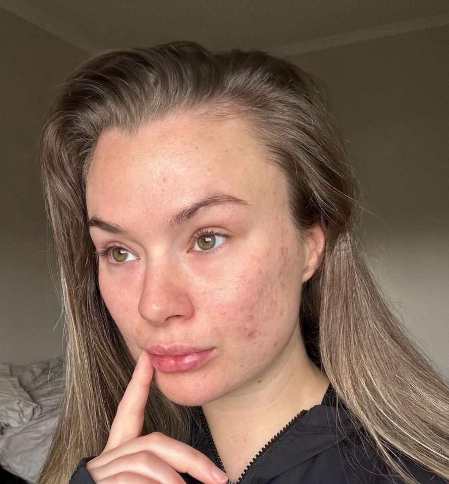 a woman with acne on her face is wearing a black jacket