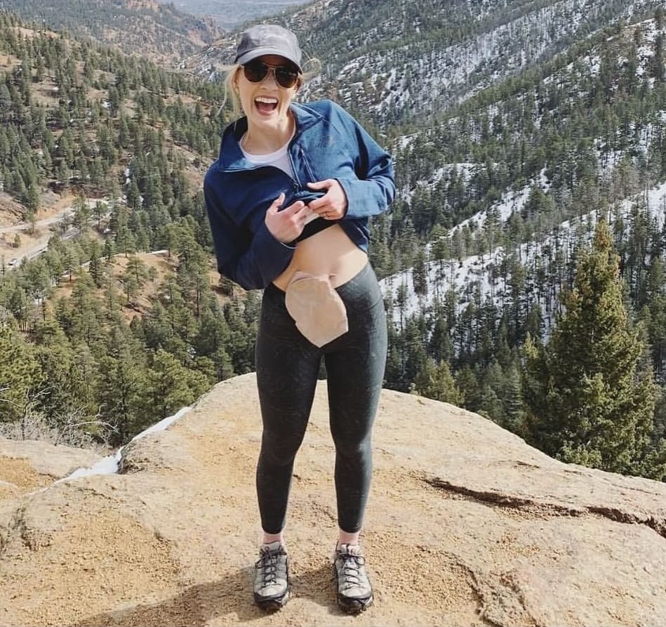 a woman with a stoma bag standing on top of a mountain