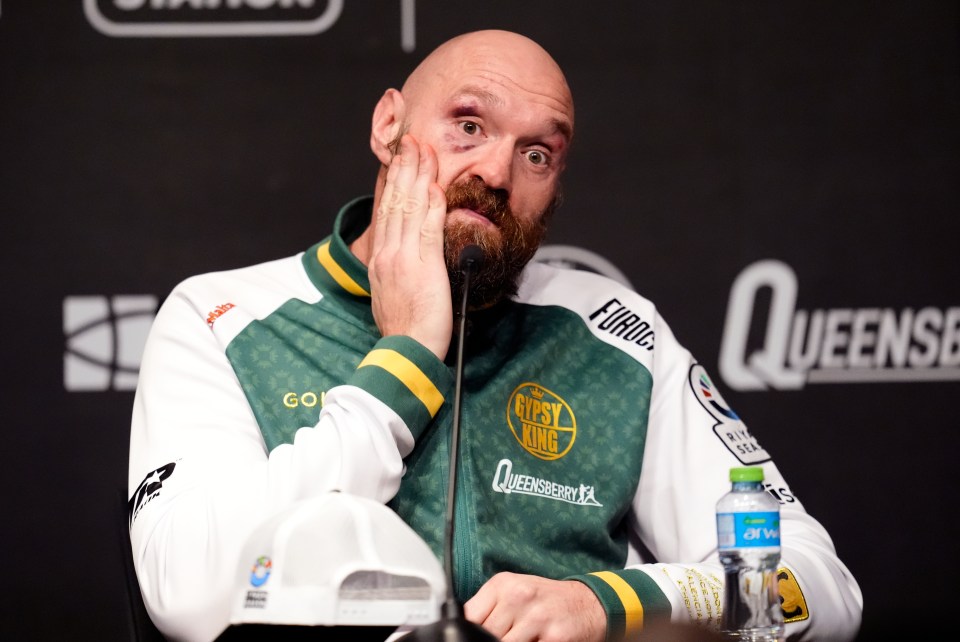 Tyson Fury at a press conference, showing a black eye.