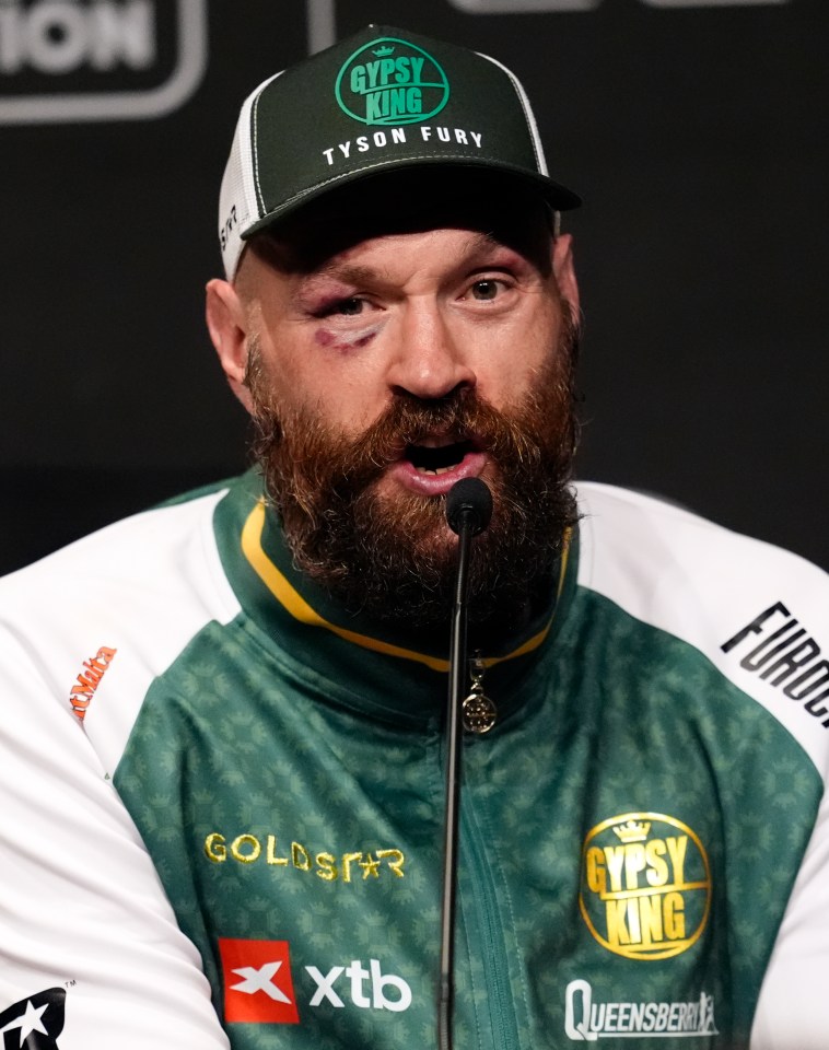 Tyson Fury at a press conference with a black eye.