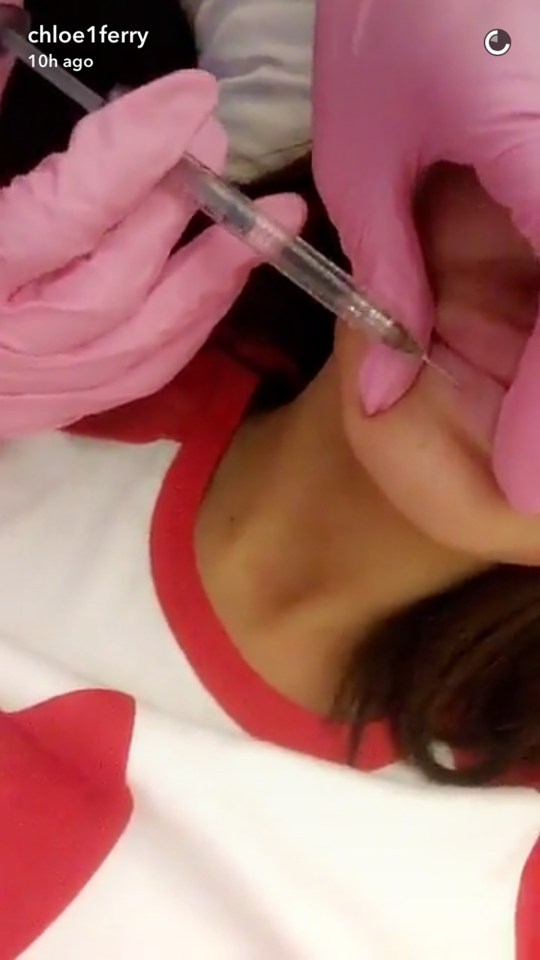 Close-up of a woman receiving lip injections.