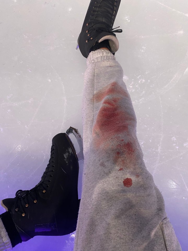 Blood-stained sweatpants and ice skates on ice.