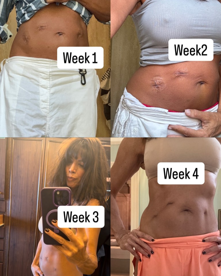 Post-hysterectomy recovery: weeks 1-4.
