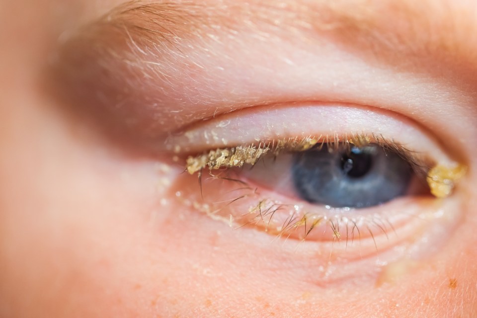 Close-up of a child's eye with purulent conjunctivitis.