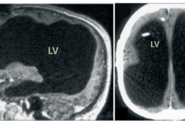 MRI and CT scans showing severe dilatation of the lateral ventricles.