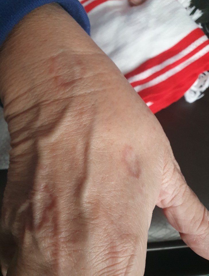 Close-up photo of a person's hand showing a skin discoloration.