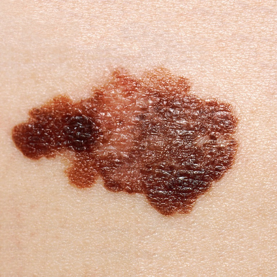 Close-up of a melanoma on human skin.