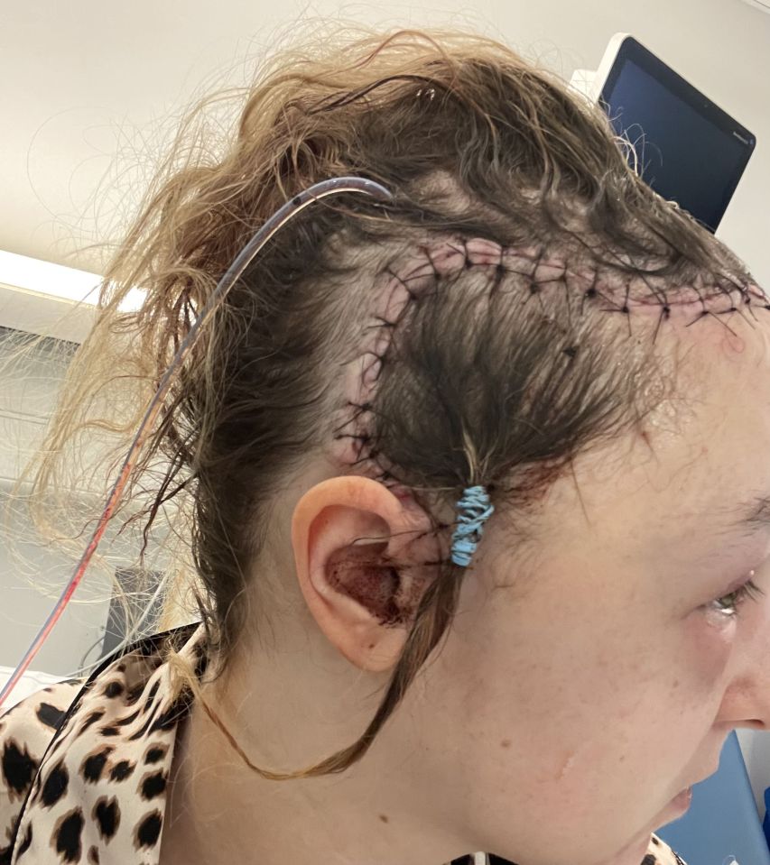 Close-up of a woman's head showing surgical scars and a drainage tube.