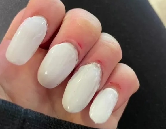 Damaged cuticles after a manicure.