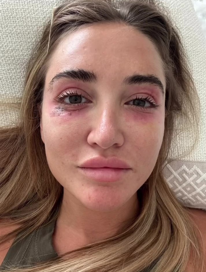 Close-up of a woman's face showing bruising around her eyes.