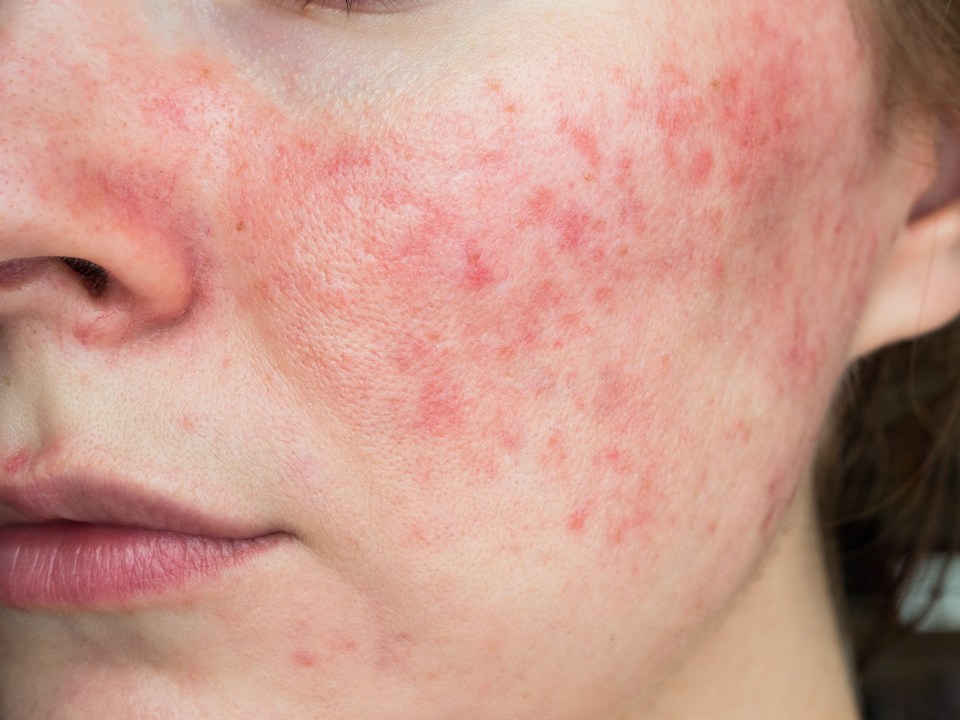 Close-up of papulopustular rosacea on a person's cheek.