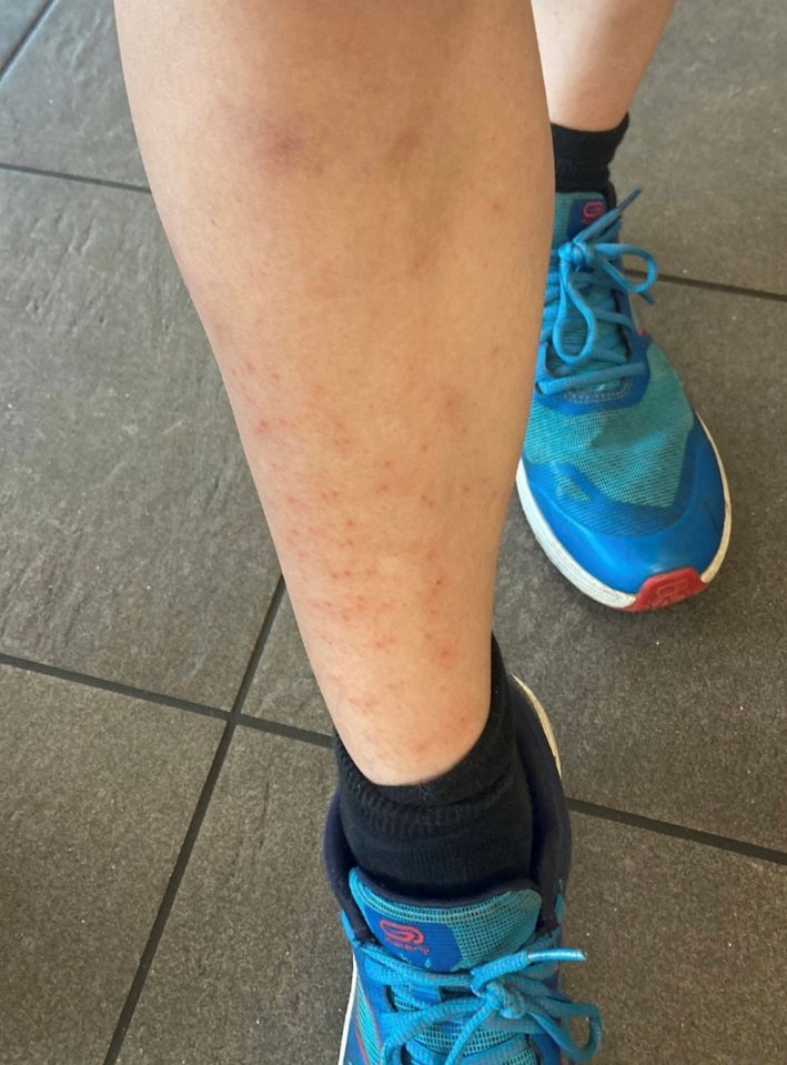 Rash on a leg from grass allergy.