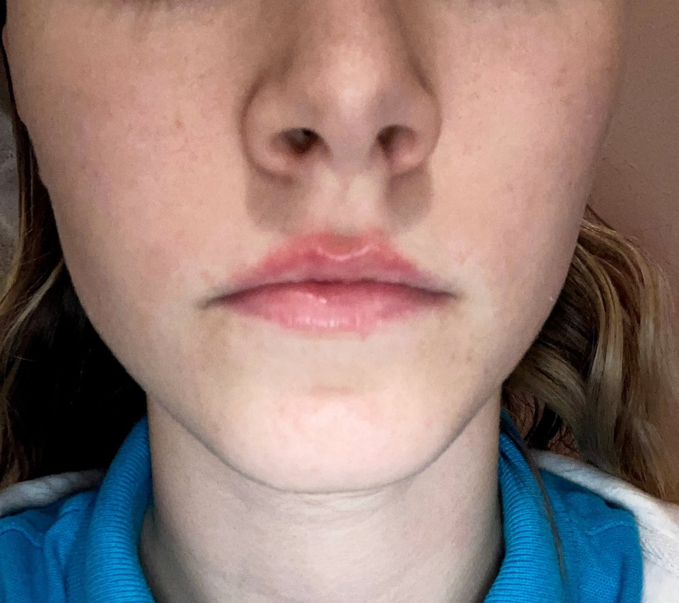 Close-up of a person's swollen lip.
