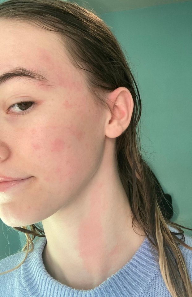 Woman's face and neck with hives after a shower due to water allergy.