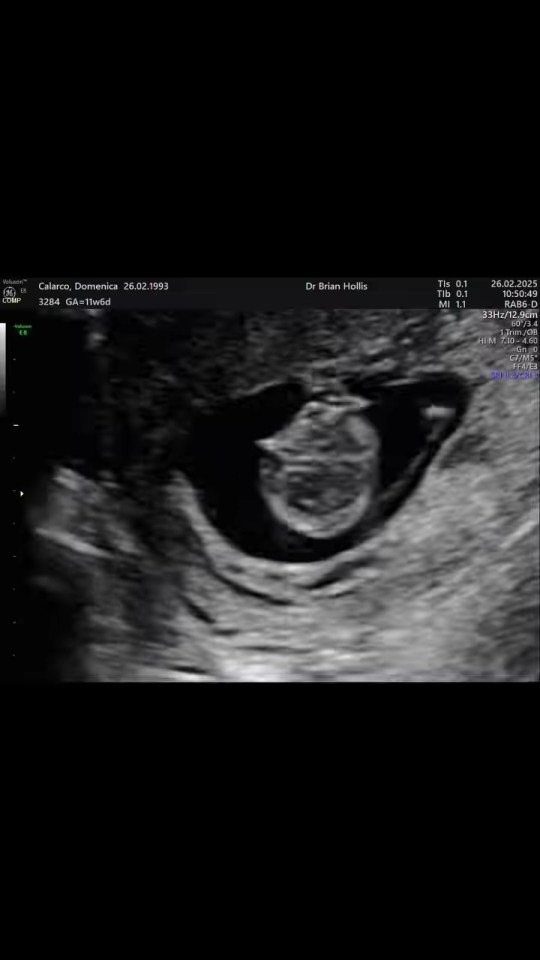 Ultrasound image of a fetus.