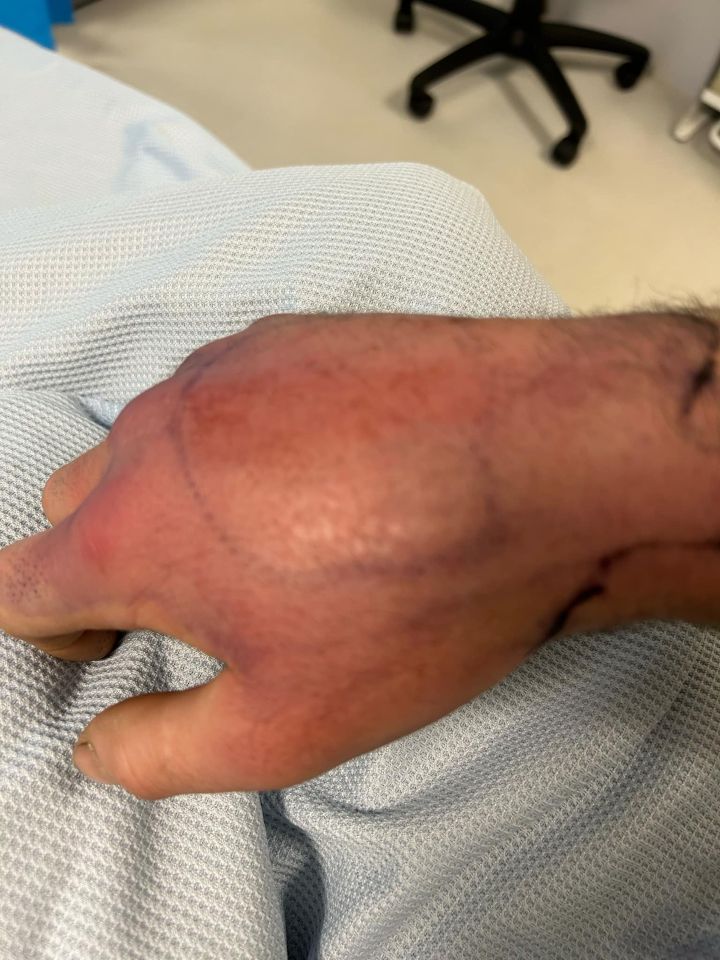 Swollen legs showing arthritic symptoms after a false widow spider bite.