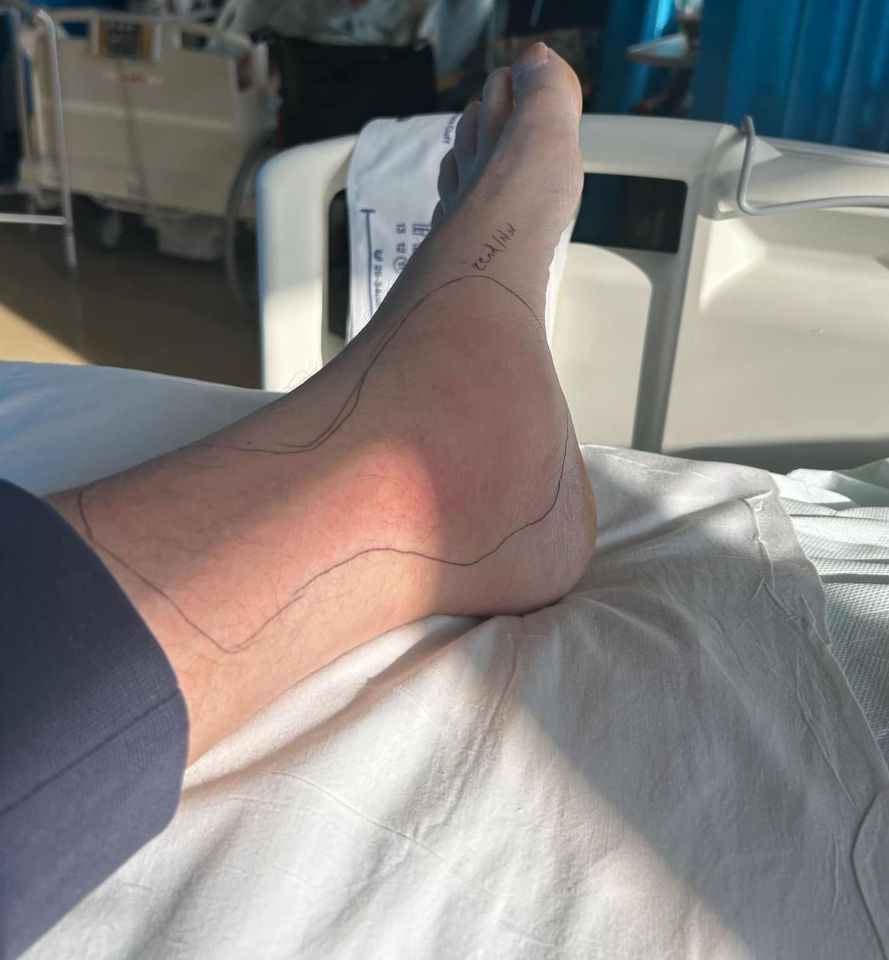 Swollen ankle with outlined inflammation.