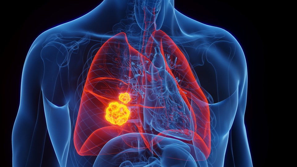 Illustration of lung cancer tumors.