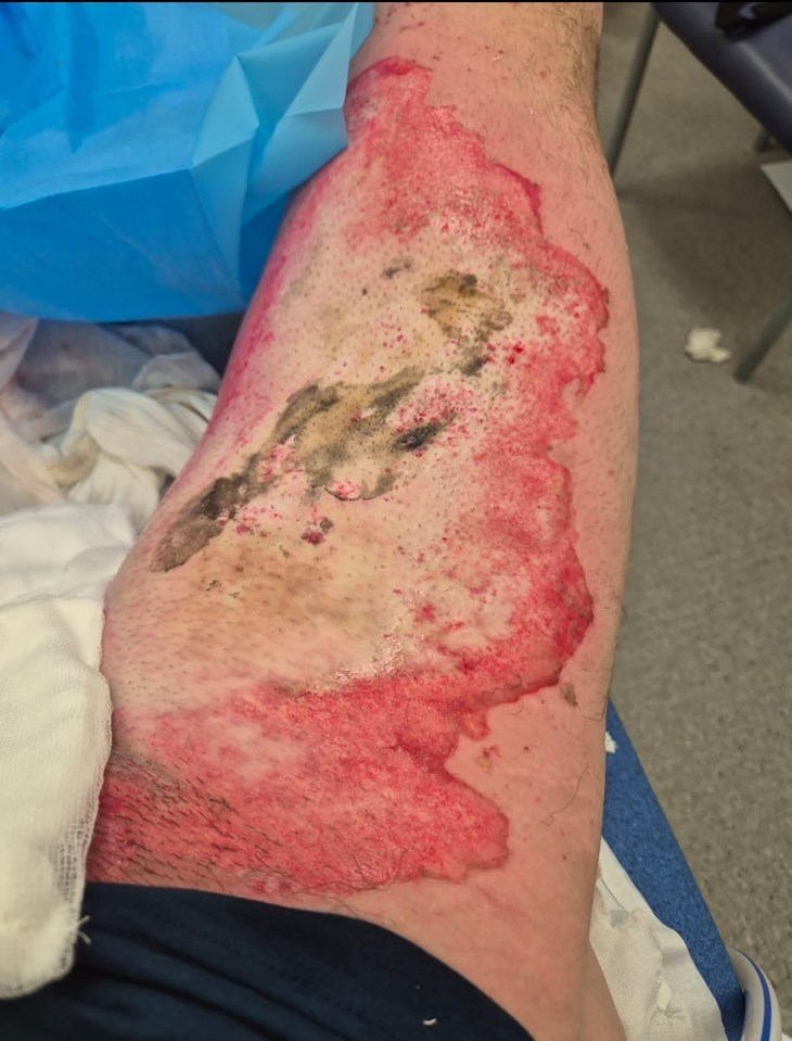 Severe third-degree burns on a man's leg from an e-cigarette battery explosion.