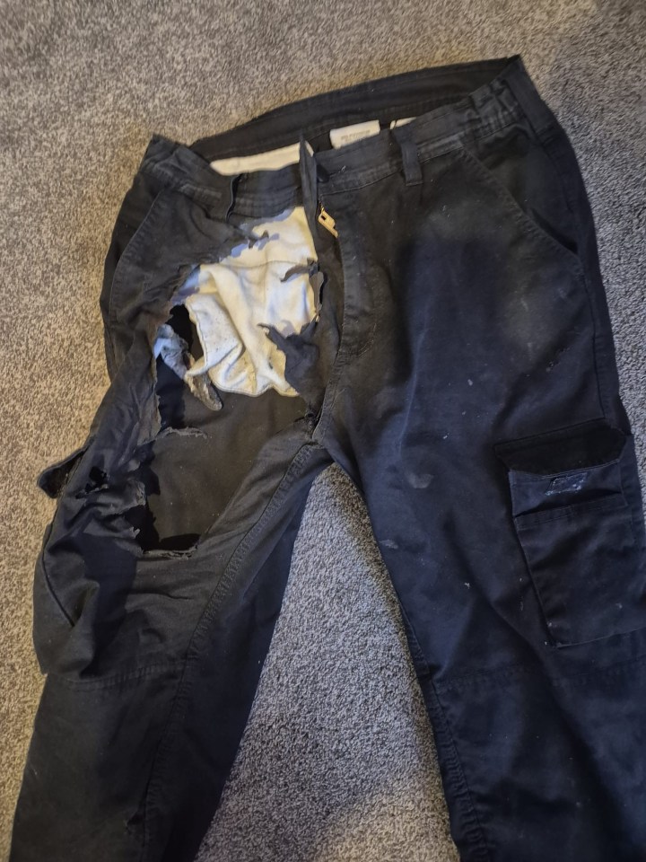 Burned trousers damaged by an exploding e-cigarette battery.