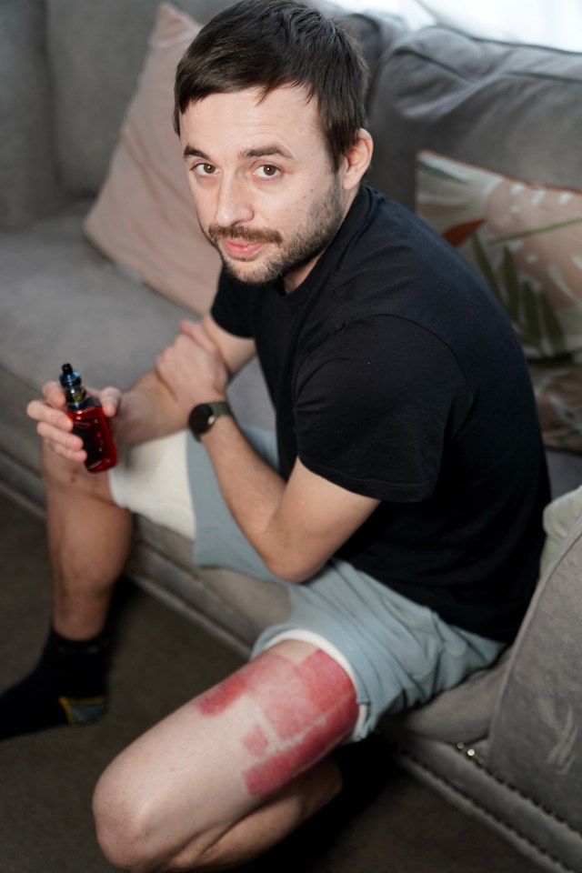 Man with third-degree burns on his leg from an e-cigarette battery explosion.