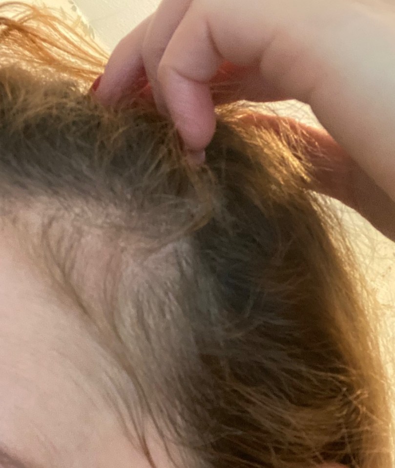Close-up of a woman's hairline showing thinning hair.
