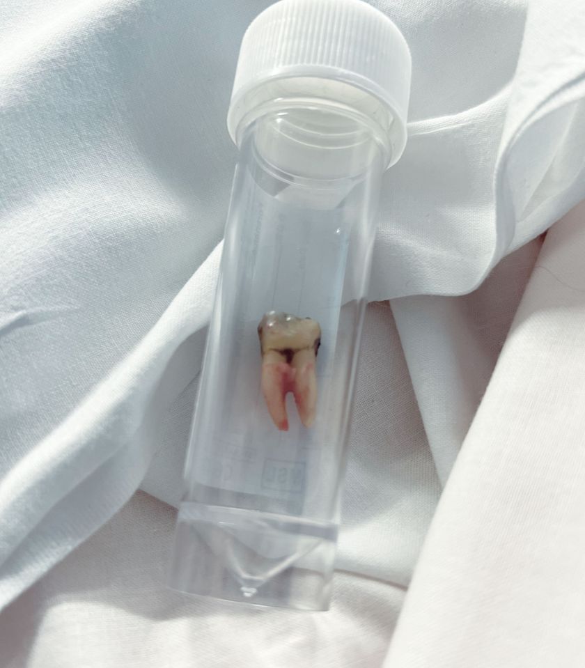 Removed wisdom tooth in a sample container.