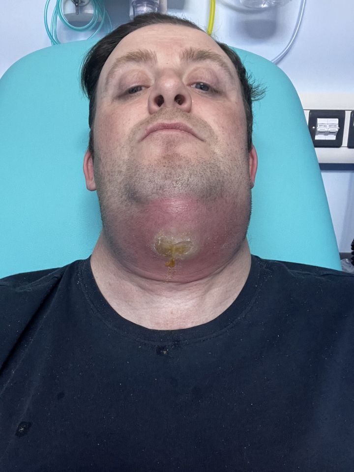 Man with severely swollen chin due to infected tooth.