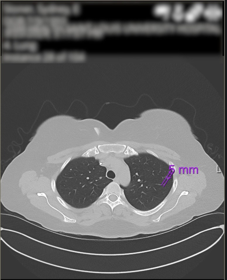 CT scan showing a 5mm lung lesion.