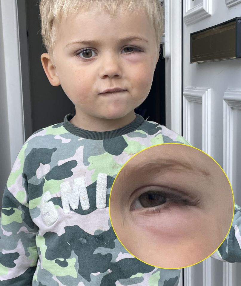 Three-year-old boy with swollen eye, diagnosed with leukemia.
