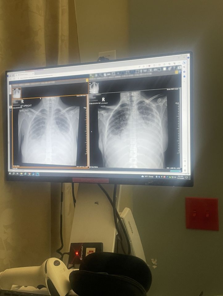 Chest X-rays displayed on a computer monitor.