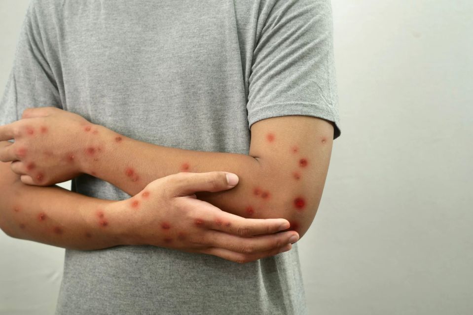 An image collage containing 1 images, Image 1 shows Person's arms with monkeypox lesions