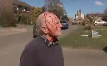 Pensioner with head injuries after hawk attack.