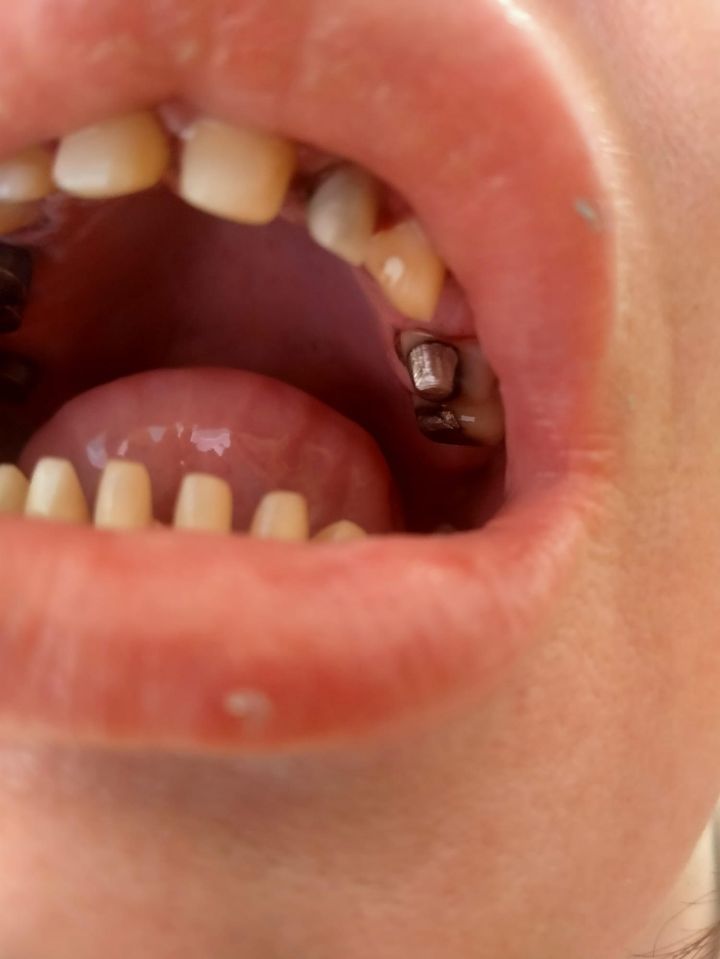 Close-up of a mouth with a dental implant.