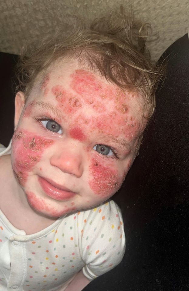 Toddler with severe eczema.