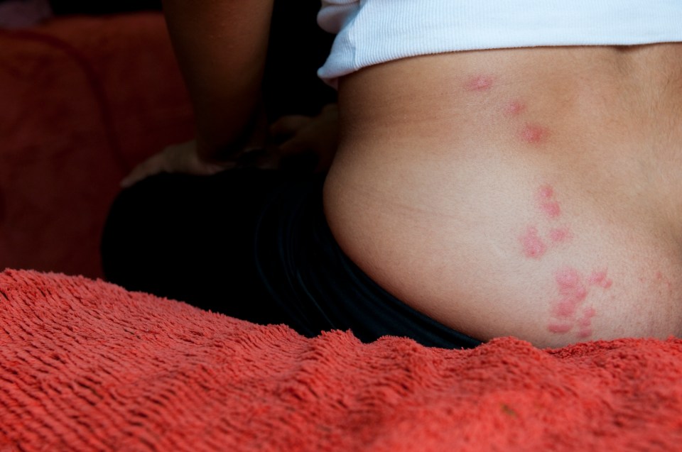 Close-up photo of itchy bed bug bites on a woman's lower back and buttocks.