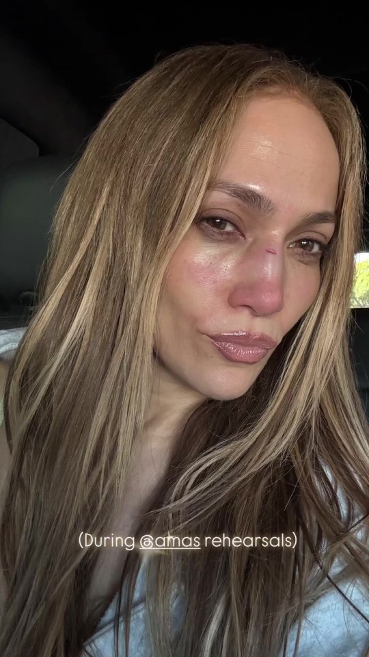 Jennifer Lopez with a facial injury during award show rehearsals.