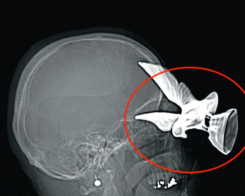 CT scan of eagle figurine lodged in a patient's eye socket.