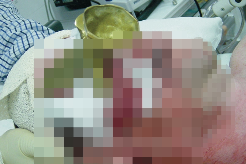 Graphic image of a man in a hospital with an injury to his eye.