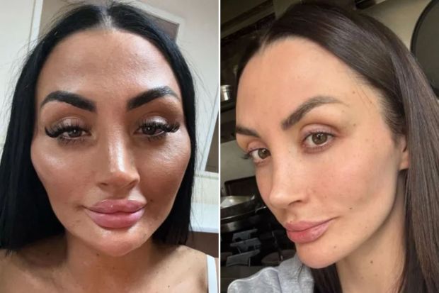 An image collage containing 2 images, Image 1 shows Close-up selfie of a woman with noticeable facial fillers, captioned &quot;Until I remember how bad my filler blindness was.&quot;, Image 2 shows Close-up of a woman's face after dissolving lip, cheek, and chin filler