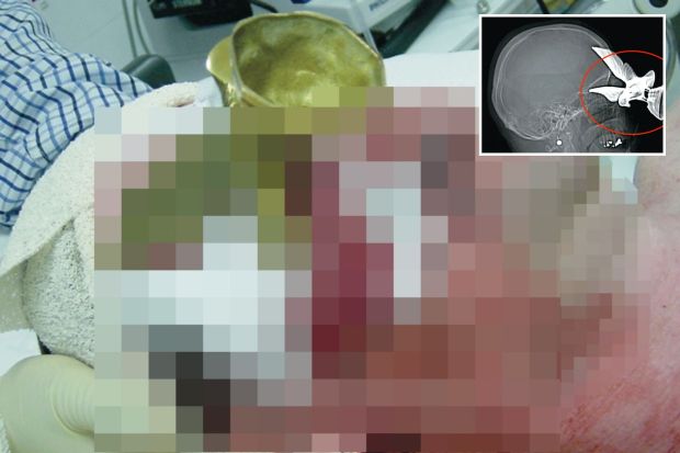 An image collage containing 2 images, Image 1 shows Graphic image of a man in a hospital with an injury to his eye, Image 2 shows CT scan of eagle figurine lodged in a patient's eye socket